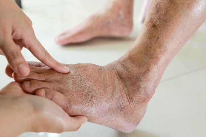 Curso de Manejo Integral del Pie Diabético y Heridas Crónicas para Enfermería