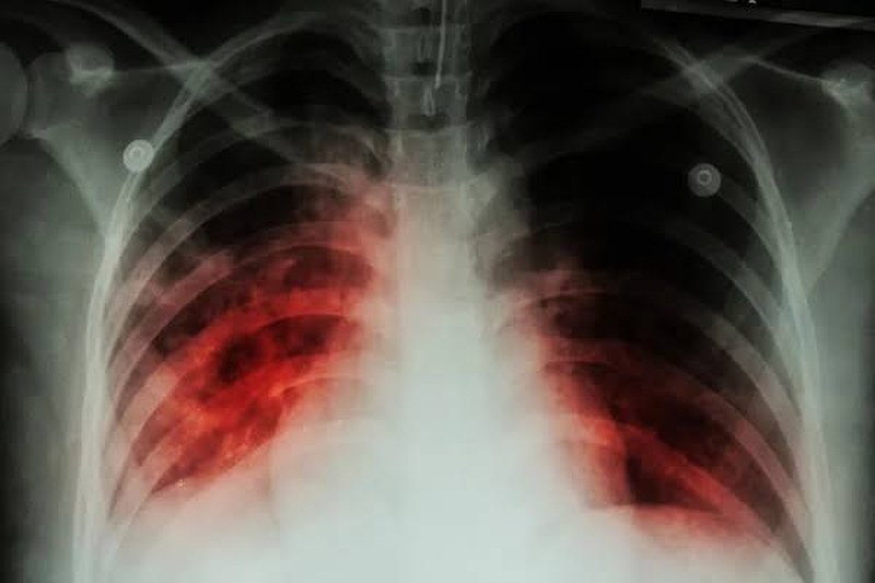 Curso Tuberculosis y Agentes Epidemiológicos
